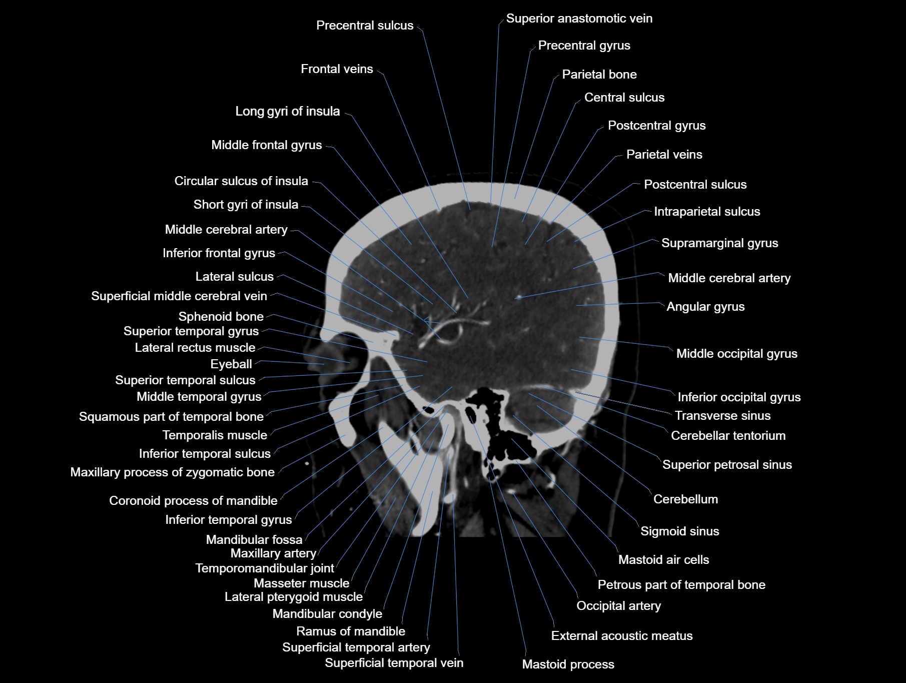CT scan brain sagittal cross sectional anatomy image-img-00001-00018.webp